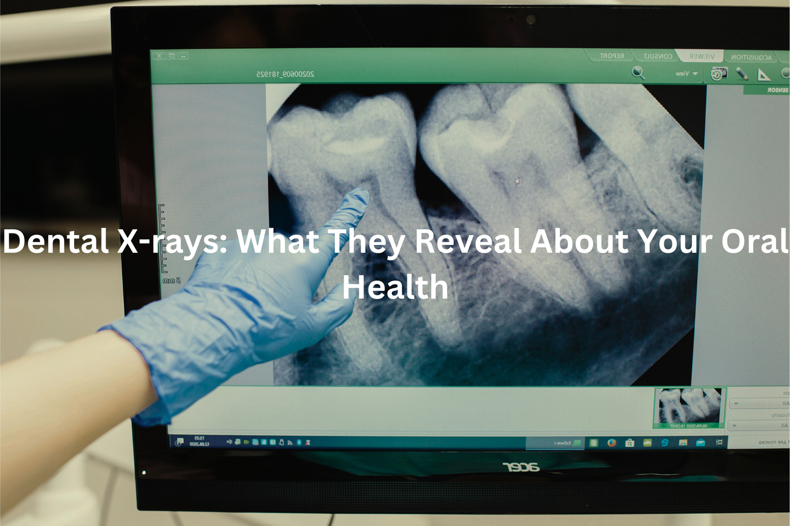 A dental X-ray image displayed on a computer screen, with a gloved hand pointing to the image. The text overlay reads "Dental X-rays: What They Reveal About Your Oral Health"