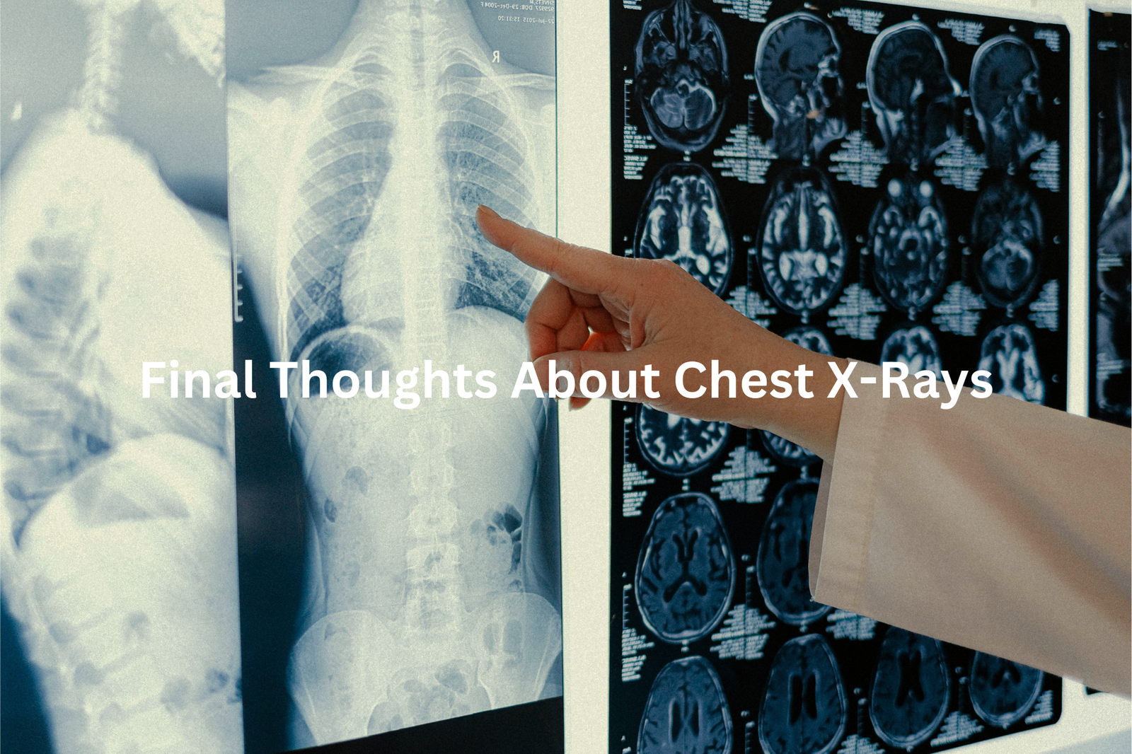 The image shows a hand pointing to a chest X-ray on a computer screen with the title Final Thoughts About Chest X-Rays overlaid on the image