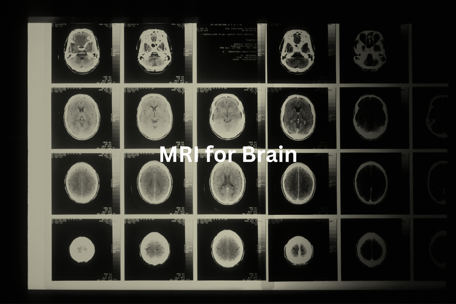 Brain MRI Scans A set of detailed magnetic resonance imaging MRI scans showing cross-sections of the human brain