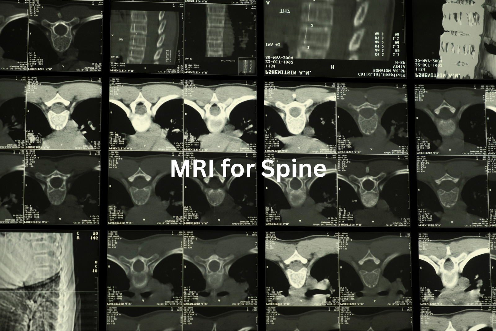 Multiple magnetic resonance imaging MRI scans of the spine displayed in a grid format with the text MRI for Spine in the center